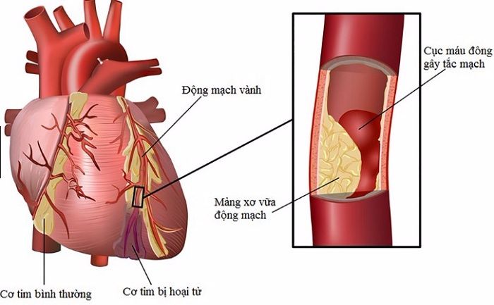 Cục máu đông ở thành mạch máu gây ra tình trạng đột quỵ