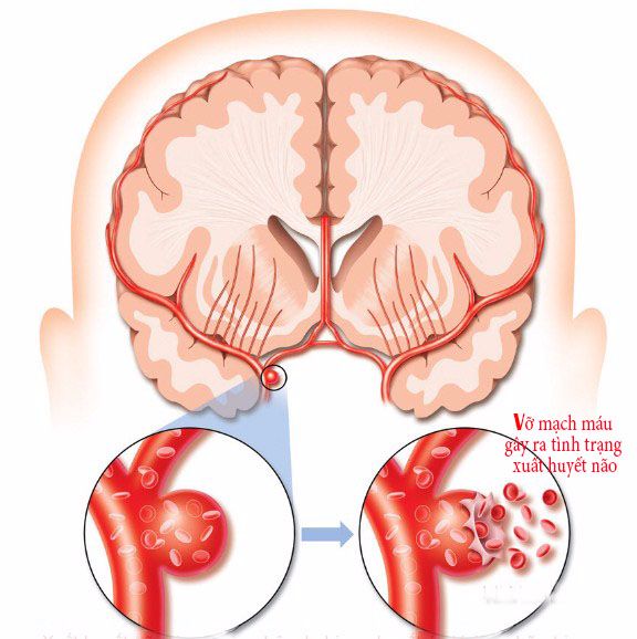 Vỡ mạch máu não gây ra tình trạng xuất huyết não